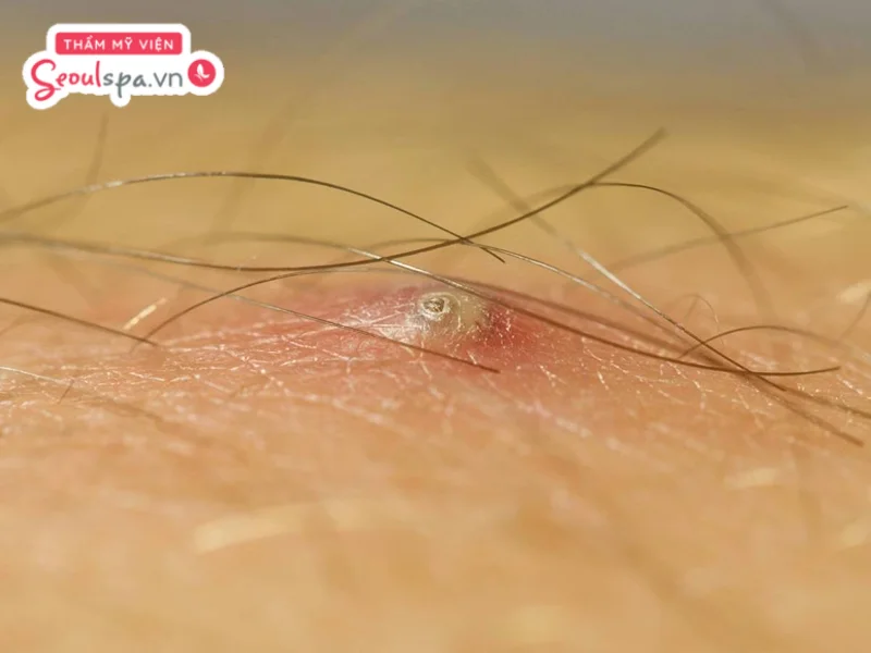 Việc nhổ lông sau khi triệt có thể khiến nang lông bị viêm