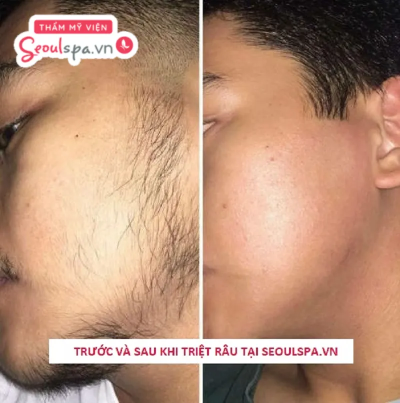 Anh Dương sau khi triệt râu quai nón