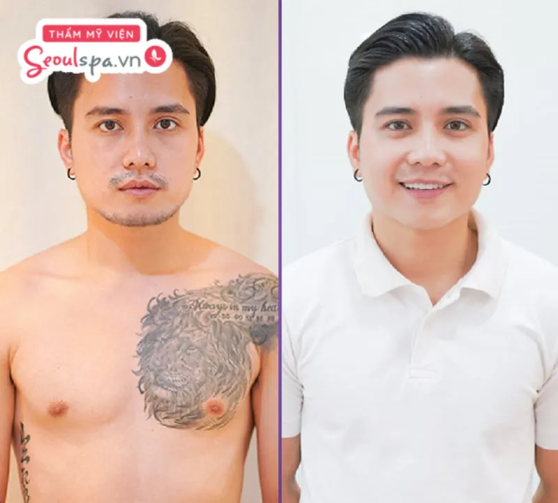 Anh Chí Sơn lấy lại vẻ đẹp trai sau khi triệt râu