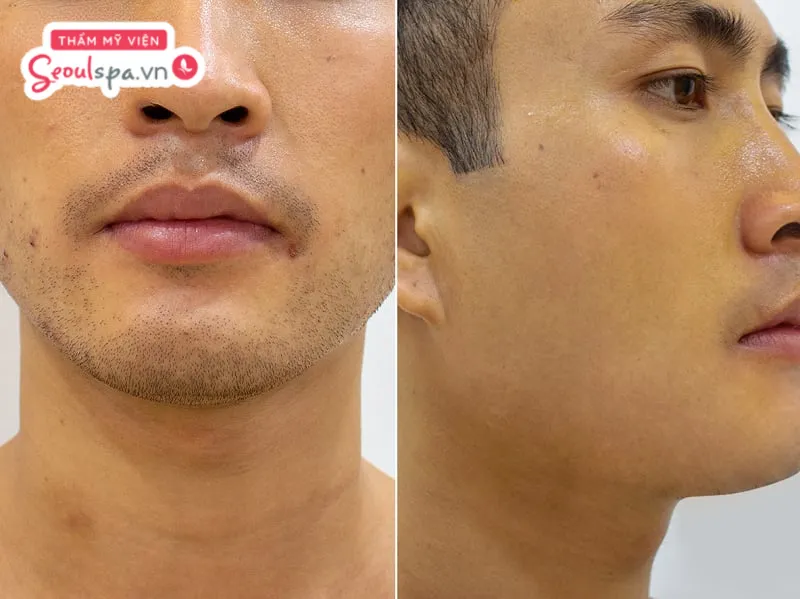 Anh Quốc Trường sử dụng phương pháp triệt râu quai nón lần đầu tại SeoulSpa.Vn