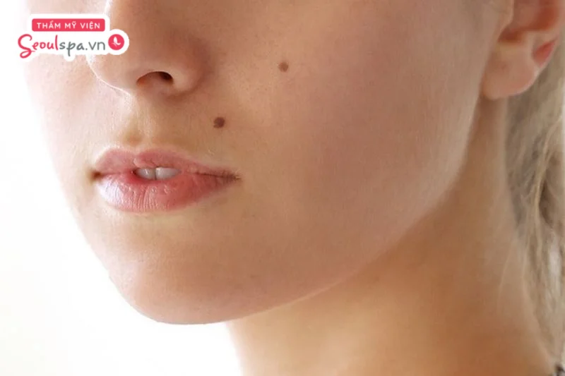 Nốt ruồi nổi bật trên mặt, thu hút sự chú ý và là lý do khiến nhiều người quan tâm đến các phương pháp cải thiện thẩm mỹ phù hợp. 