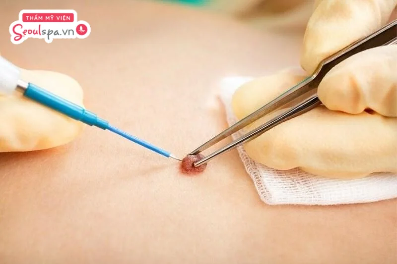 Nốt ruồi được loại bỏ bằng công nghệ đốt điện, giúp xử lý nhanh chóng tuy nhiên có thể tác động đến vùng da xung quanh