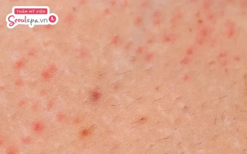 Làn da dễ xuất hiện nguy cơ viêm nhiễm và viêm nang lông khi thực hiện triệt lông trong ngày kinh nguyệt