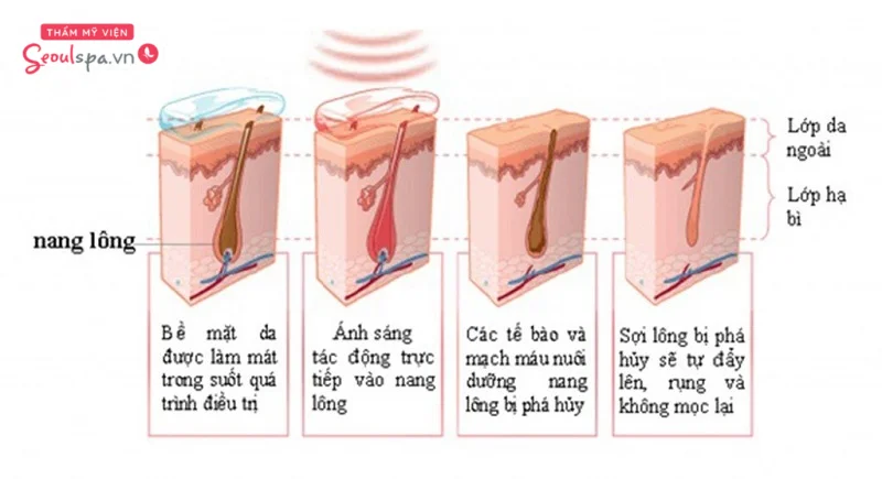Quá trình các sợi lông được loại bỏ