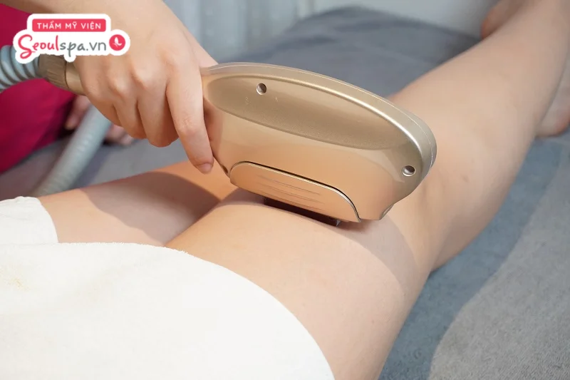 Chi phí triệt lông sẽ phụ thuộc vào vùng lông triệt, điển hình như triệt chân thì chi phí sẽ cao hơn ở nách