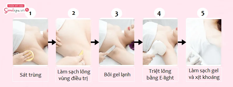 Quá trình triệt lông chuyên sâu tại Seoul Spa