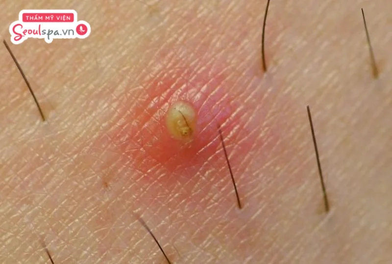 Tình trạng lông mọc ngược có thể gây sưng viêm các nang lông
