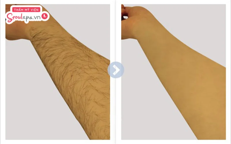 Triệt lông tay không gây mất lộc và ảnh hưởng đến tiền tại, vận phú quý nhiều người nếu xét trên góc độ khoa học
