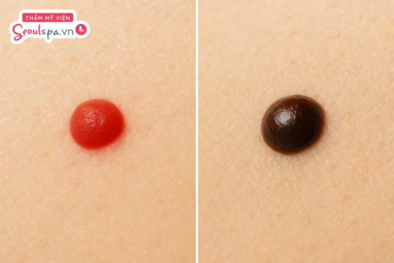 So sánh nốt ruồi son và nốt ruồi đen