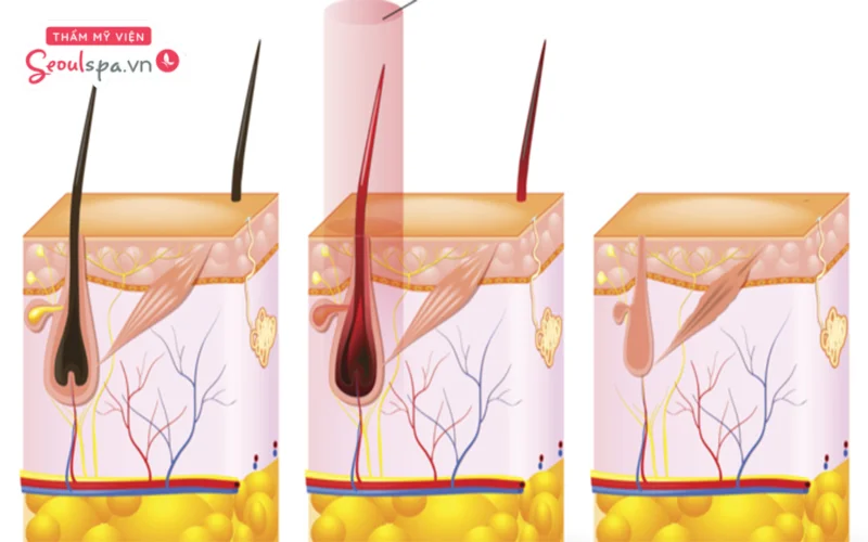 Công nghệ triệt lông IPL