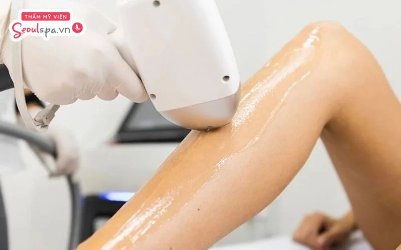 Công nghệ Diode Laser tác động trực tiếp vào nang lông, giúp giảm lông hiệu quả và mang lại cảm giác nhẹ nhàng nhờ tích hợp hệ thống làm mát.