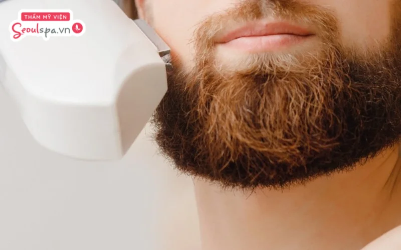Quy trình triệt râu vĩnh viễn tại thẩm mỹ viện