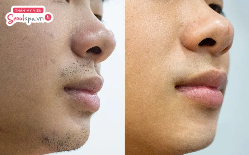 Anh Hoàng Nam (29 tuổi) triệt râu trong lần đầu tiên