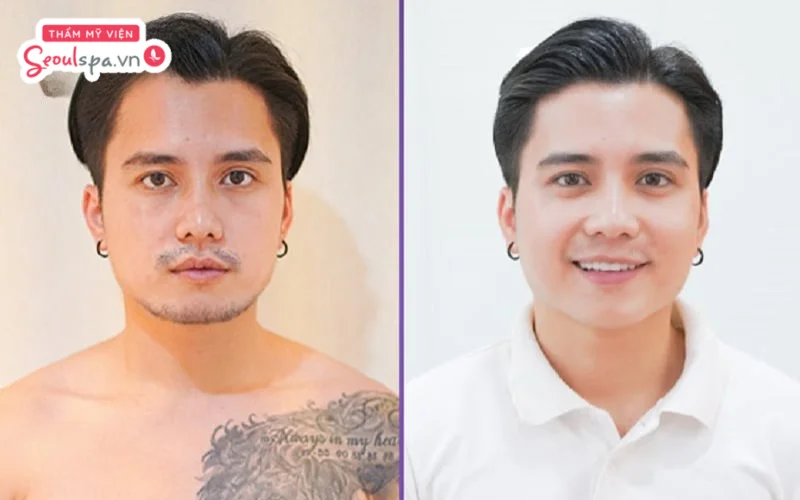 Anh Hoàng Hà cảm thấy vui vẻ sau khi loại bỏ râu hoàn toàn