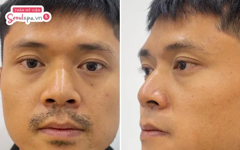 Anh Thế Anh (27 tuổi) sau khi triệt râu vĩnh viễn