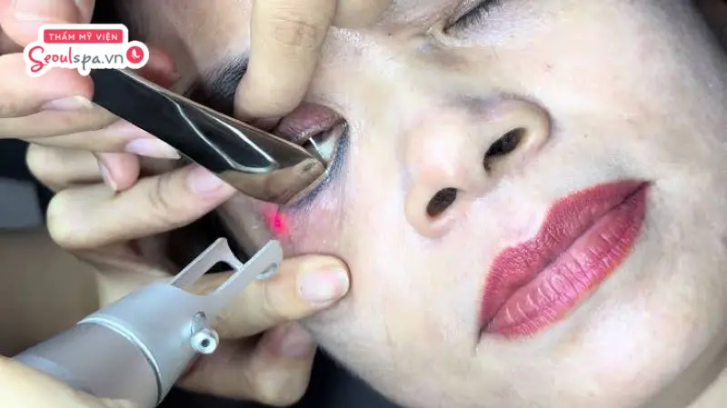 Bắn laser công nghệ cao là giải pháp xóa xăm mí mắt an toàn được chuyên gia khuyên dùng