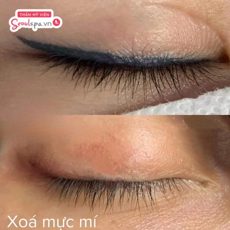 Xóa xăm mí mắt tại Thẩm mỹ viện Seoul Center mang lại hiệu quả triệt để, đảm bảo an toàn