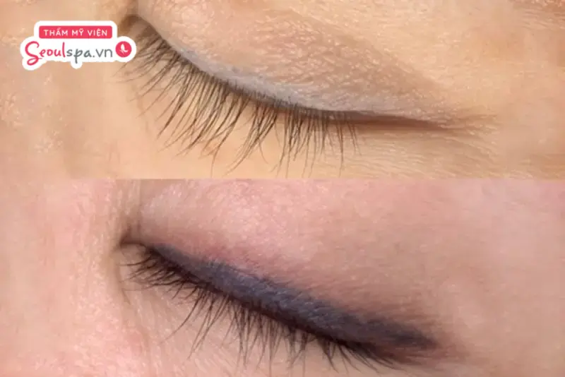 Sự thay đổi rõ rệt trước và sau khi thực hiện liệu trình xóa xăm mí mắt bằng laser.