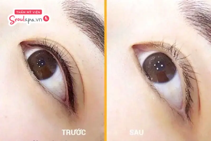 Làn da mí mắt phục hồi mịn màng, đều màu và không hề có dấu vết sẹo sau khi xóa.
