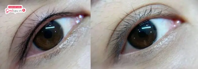 Nhờ bước sóng laser được điều chỉnh phù hợp, vùng mí mắt sau khi xóa hoàn toàn đều màu, mịn màng và không để lại sẹo hay dấu vết thẩm mỹ nào