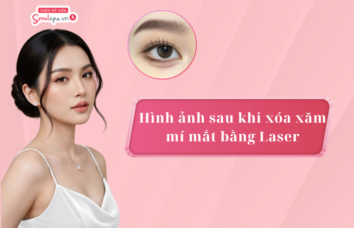 Hình ảnh sau khi xóa xăm mí mắt bằng Laser