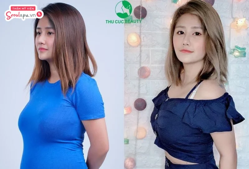 Hiệu quả khách hàng khi giảm béo tại Thẩm mỹ viện Thu Cúc