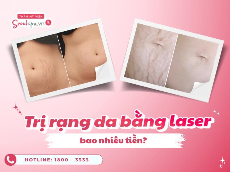 Trị rạn da bằng laser bao nhiêu tiền
