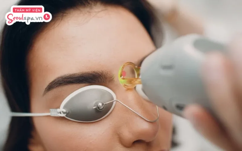 Triệt lông mày thừa bằng công nghệ cao