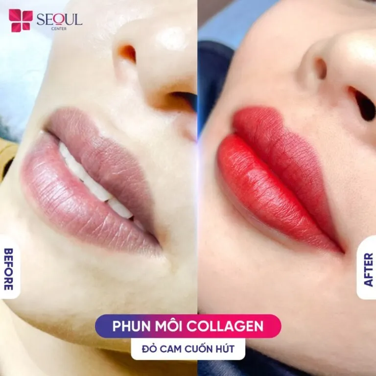 Hiệu quả trước và sau khi phun môi collagen tại Thẩm mỹ viện SeoulSpa.Vn