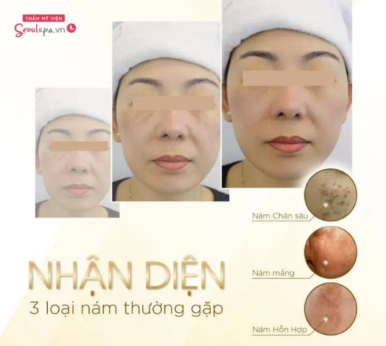 Có 3 loại nám chính đó là nám mảng, nám chân sâu và nám hỗn hợp