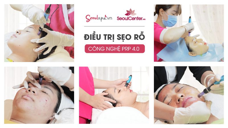 Điều trị sẹo rỗ bằng công nghệ PRP 4.0