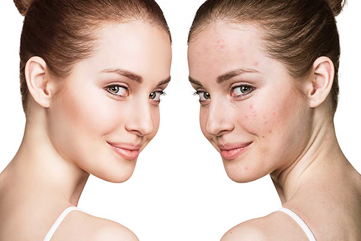 có nên đi spa trị mụn không