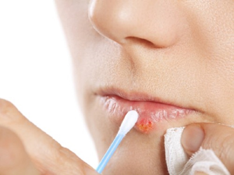 Top 20+ Thuốc Bôi Acyclovir Stada Cream Có Tác Dụng Gì Acyclovir bôi môi có tác dụng gì? Cách bôi acyclovir sau phun môi 24 Dùng tăm bông lấy thuốc Acyclovir bôi lên vị trí môi bị mụn nước, không bôi vùng da lành