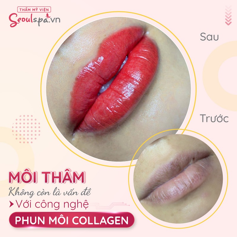 Ngỡ ngàng trước kết quả phun môi đẹp tại Seoul Spa