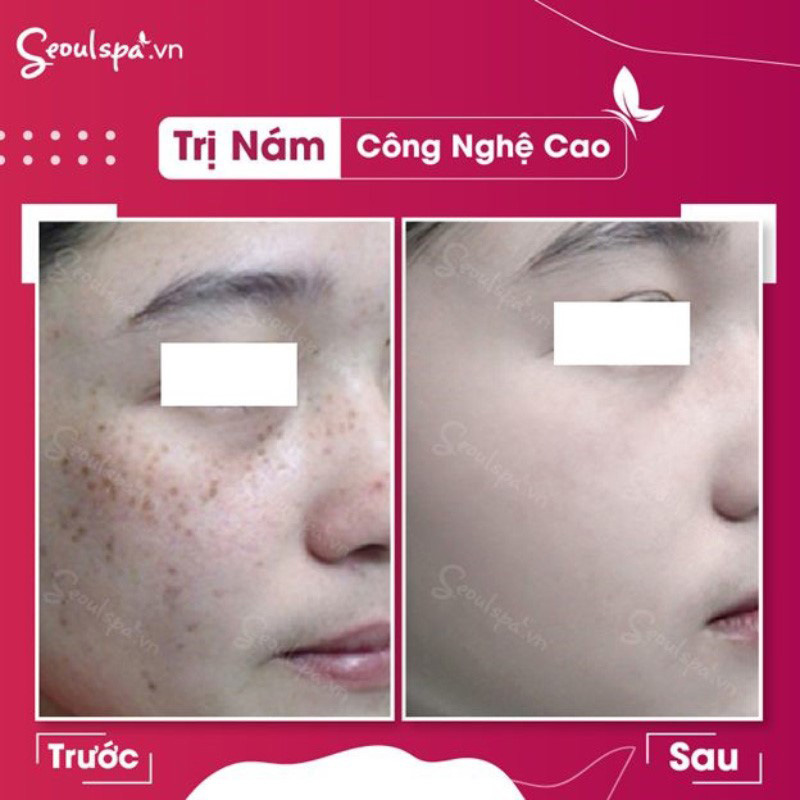 Các công nghệ trị nám tại Seoul Spa sẽ giúp khách hàng đánh sạch nám, da mịn màng, trắng sáng hơn