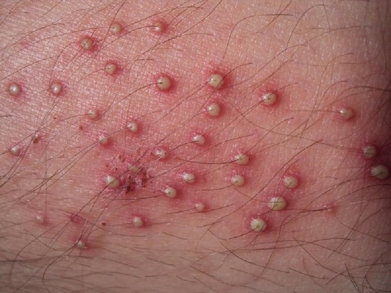 Cách khắc phục tình trạng cạo lông vùng kín bị nổi mụn là rửa bằng nước muối sinh lý, bôi thuốc mỡ để giảm mụn