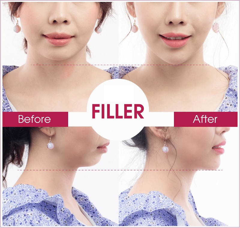 Chuỗi Thẩm Mỹ Viện của Seoul Spa là địa chỉ tiêm filler uy tín hàng đầu hiện nay