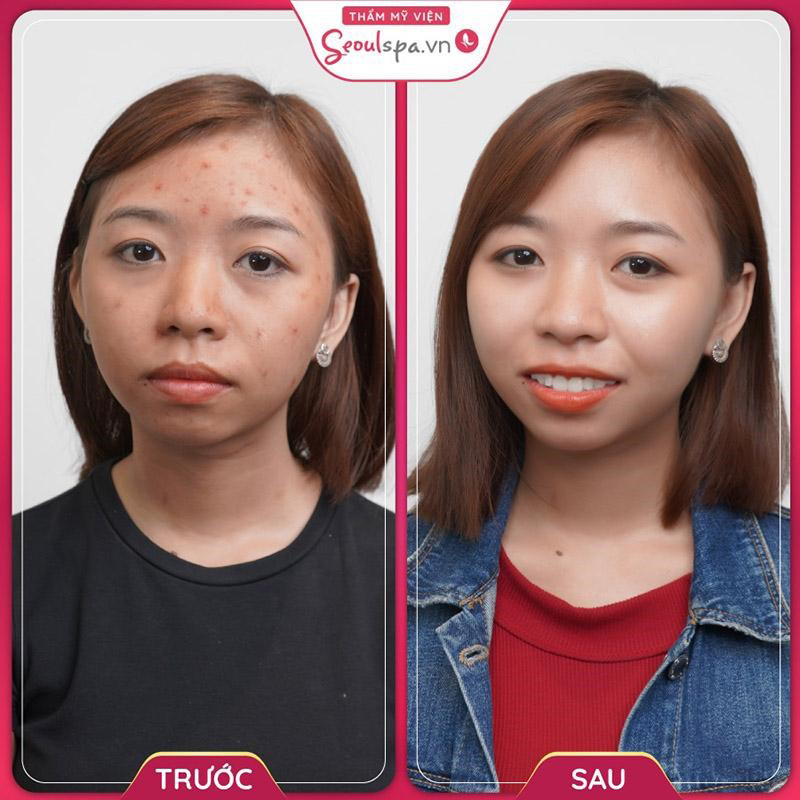 Mang đến hiệu quả trị mụn nội tiết tuyệt vời với làn da mịn màng