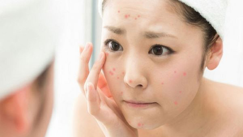 Do căng thẳng, mệt mỏi dẫn đến mụn