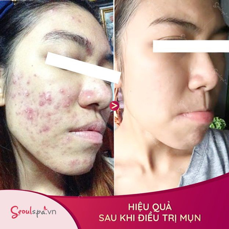 Top 20+ Làm Sạch Mụn Đầu Đen Bằng Baking Soda Những cách trị mụn bằng baking soda ngay tại nhà 63 Vừa mang đến hiệu quả trị mụn vừa giúp da căng mịn, trắng sáng