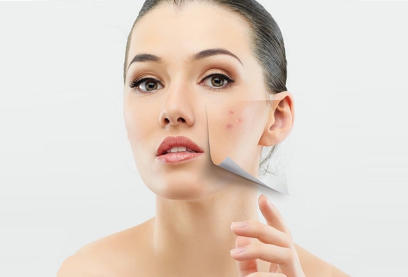 Những điều cần biết về mụn ẩn để chăm sóc da tốt hơn