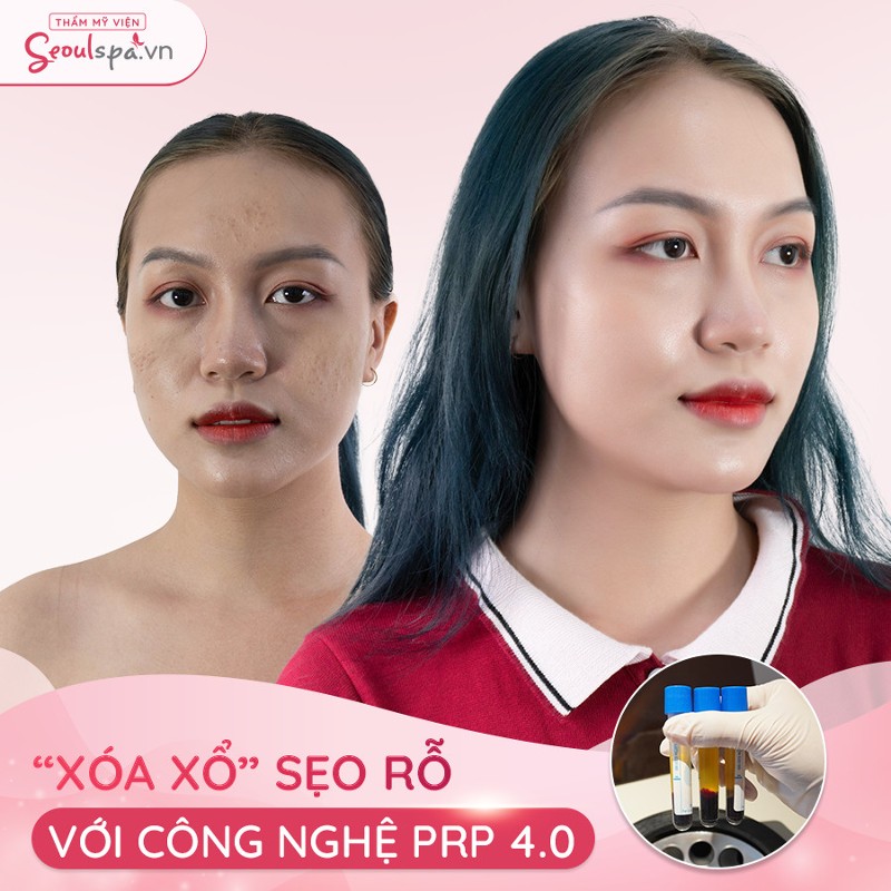 Top 20+ Mặt Bị Rỗ Có Chữa Được Không “Tuyệt chiêu” giúp phục hồi da mặt bị rỗ hiệu quả | SeoulSpa.Vn 63 Hiệu quả trị sẹo được đánh giá vô cùng cao nhờ khả năng kích thích sản sinh collagen và các tế bào mới liên tục