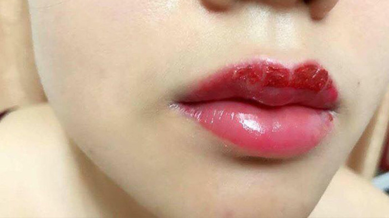 Lớp vảy trên môi bong ra sau 1 tuần
