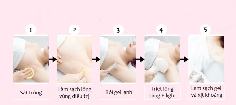 Quy trình triệt lông tại cơ sở làm đẹp uy tín an toàn và hiệu quả tốt hơn triệt tại nhà