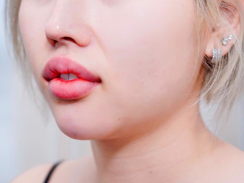 Top 20+ Tiêm Filler Môi Bao Lâu Thì Hết Sưng Tiêm filler xong bị sưng là do đâu? Cách khắc phục tình trạng này 36 Tình trạng tiêm filler xong bị sưng