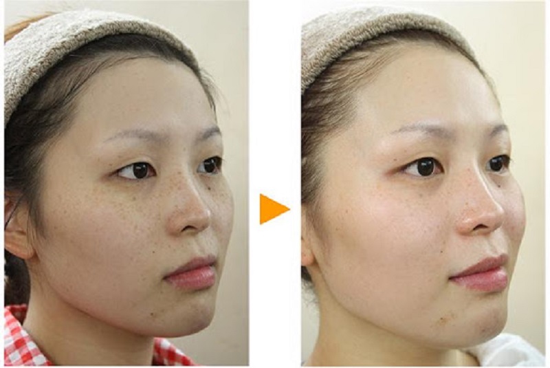 Top 20+ Cây Mã Đề Có Tác Dụng Chữa Bệnh Gì Cây mã đề trị mụn có tốt không? Những lưu ý khi sử dụng loại cây này? 23 Chuối cũng có khả năng làm giảm sắc tố da và làm sáng da