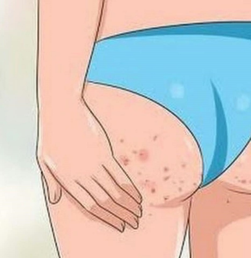 Top 20+ Kem Trị Thâm Háng Mông Hàn Quốc Eunyul Cập nhật 10 cách trị thâm mông tại nhà nhanh chóng hiệu quả nhất 2022 60 Không tẩy tế bào chết cho da mông cũng là nguyên nhân khiến nó bị thâm, đốm nâu, da sần sùi