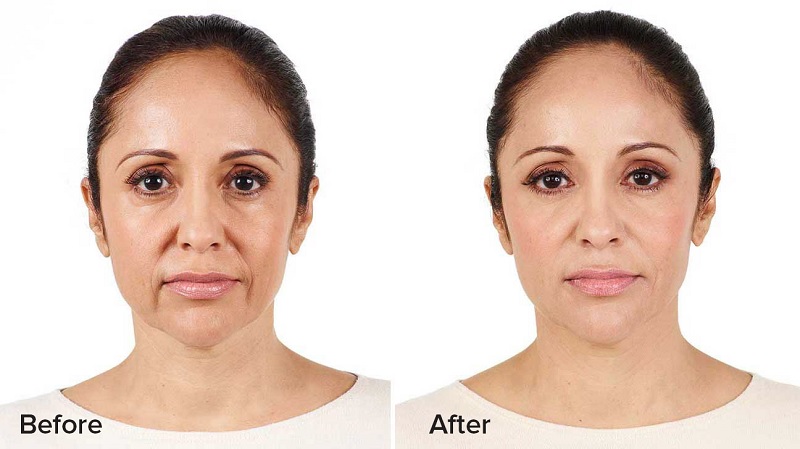 Top 20+ Những Điều Cần Biết Khi Tiêm Filler Tiêm filler là gì? Những vấn đề cần biết trước khi tiêm 20 Tiêm filler giúp phục hồi và cải thiện các khuyết điểm trên khuôn mặt