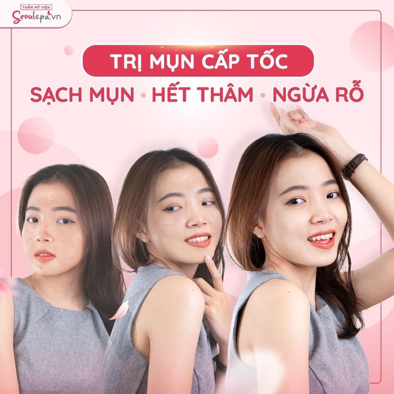 Loại bỏ mụn vĩnh viễn khi trị mụn bằng công nghệ phi kim tại Seoul Spa