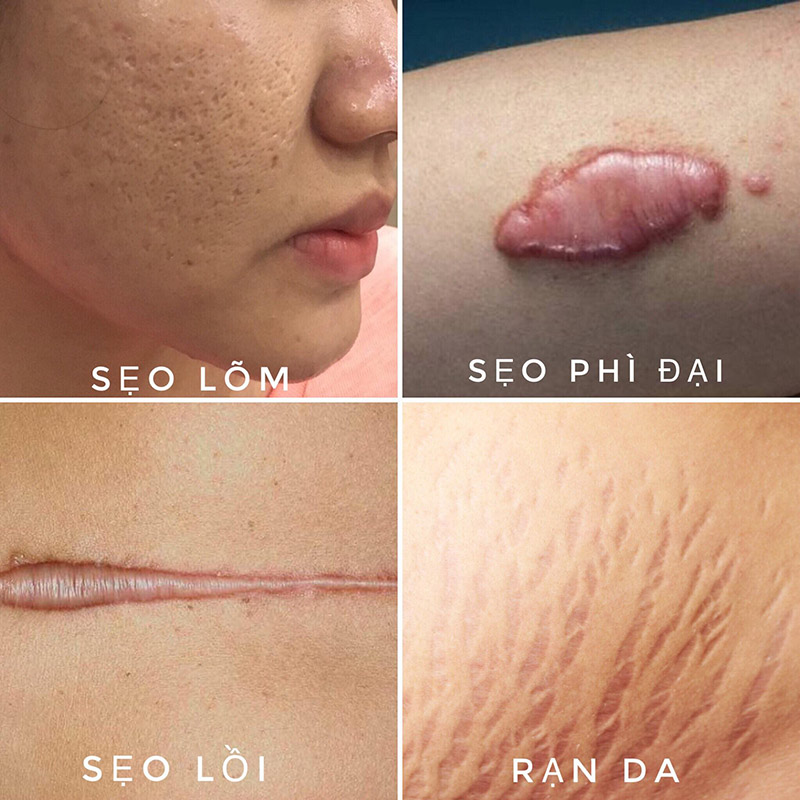 Top 20+ Thuốc Trị Sẹo Xeragel Giá Bao Nhiêu Bôi kem trị sẹo trước hay sau serum để phát HIỆU QUẢ quả tối đa 40 Xác định chính xác loại sẹo trên da mặt được xem là bước vô cùng quan trọng
